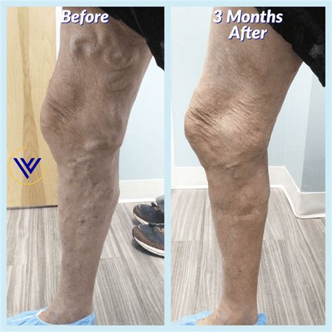 Is Varicose Vein Treatment Painful Center For Varicose Veins Board