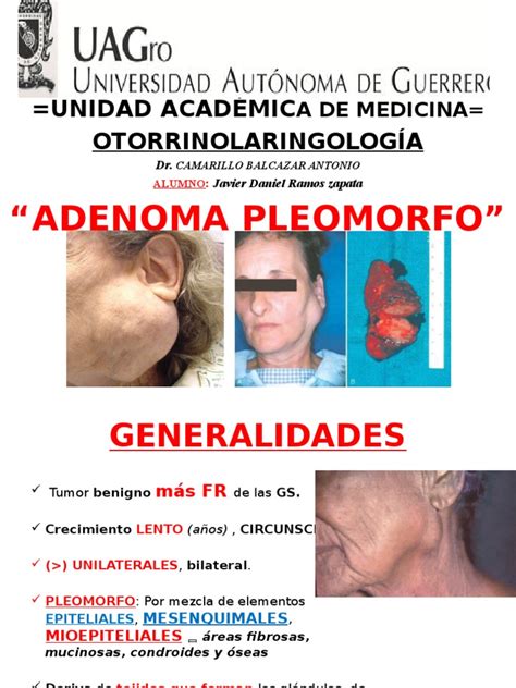 60% of parotid gland tumours. Adenoma Pleomorfo | Cáncer | Enfermedades y trastornos