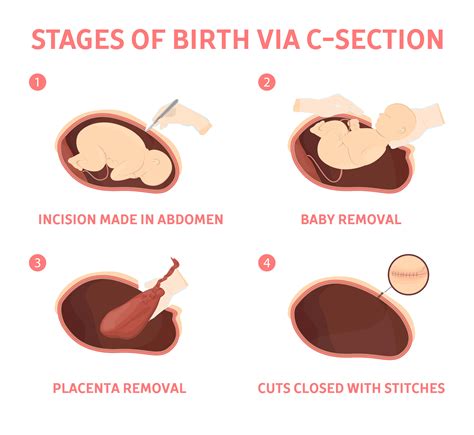 And remember, the type of birth you have is secondary to the most important thing of all: Benefits & Risks of Vaginal Delivery vs. Cesarean Section