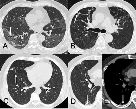 Follow Up Chest Ct Characteristics Of Covid 19 Pneumonia A Traction