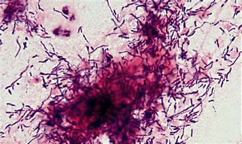 Actinomycosis Gram Stain