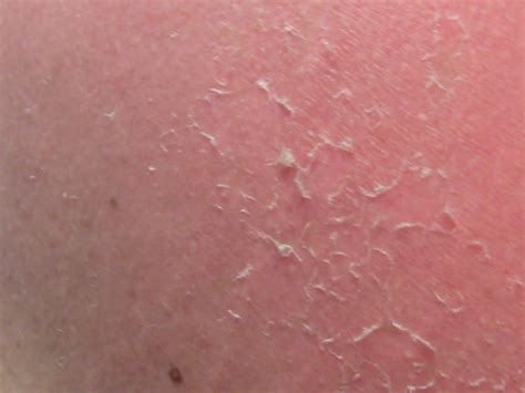 Peeling Skin Causes Symptoms Diagnosis And Treatment Safe Home Diy