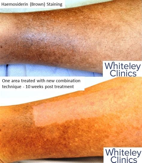 Brown Stains On Legs Amazing New Treatment The Whiteley Clinic
