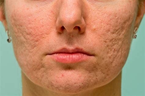 Common Acne Scars And How To Get Rid Of Them The Healthy