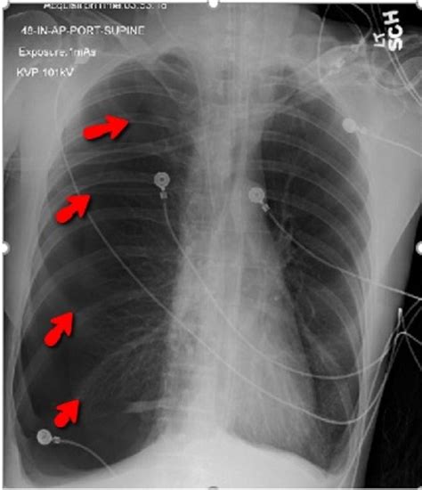 Tension Pneumothorax And Diffuse Subcutaneous Emphysema As A My Xxx