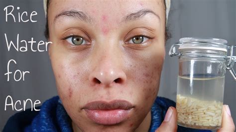 RICE WATER FOR ACNE DARK CIRCLES BEFORE AFTERS YouTube