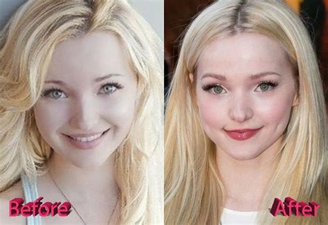 Dove Cameron Lips Before And After Dovecameronplasticsurgery Dovecameron Dovecameronlips