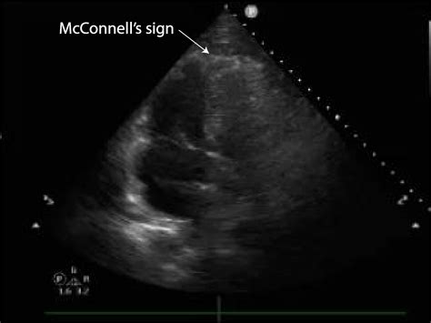 Lung Ultrasound For Pulmonary Embolism Critical Care Sonography