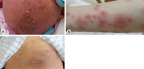 A Case Of Pruritic Urticarial Papules And Plaques Of Pregnancy