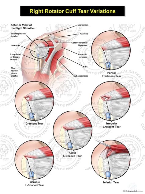 Rotator Cuff Tear Classifications The Diagram Represents The My Xxx Hot Girl