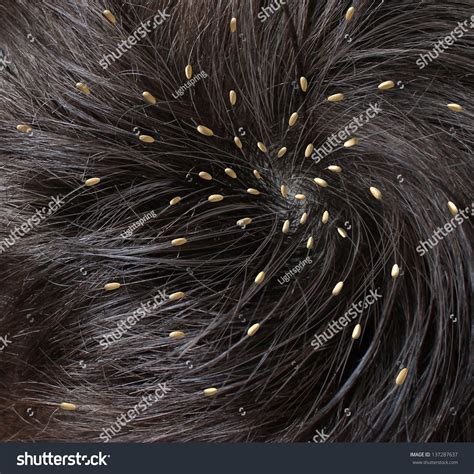 Head Lice Medical Concept As A Close Up Of A Human Head With An