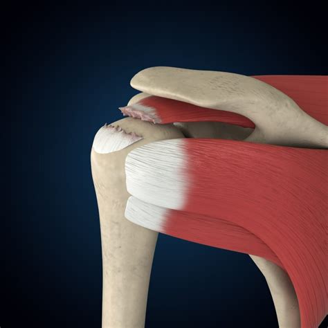 Rotator Cuff Tear Signs And Symptoms Jeremy Burnham Md