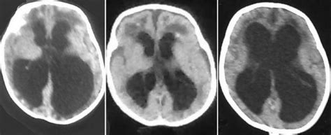 Left Ct Brain Showing Obstructive Hydrocephalus With Dilated Lateral