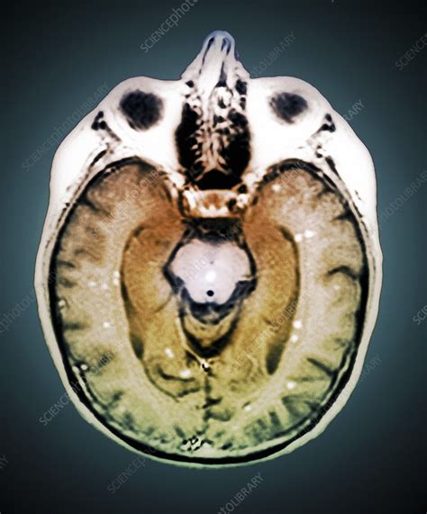 Secondary Brain Cancer Mri Scan Stock Image F0039163 Science