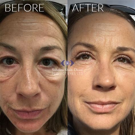 Natural Looking Eye Bag Surgery By Leading Cosmetic Eye Surgeon