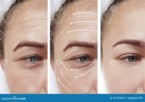 Woman Skin Face Wrinkles Surgery Contrast Results Correction Before And