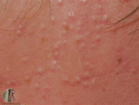 Types Of Acne With Pictures Mild Moderate Severe Ehealthstar