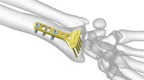 Extra Articular Ex Plate Acumed