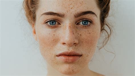 What It Really Means When You Have Freckles On Your Hands