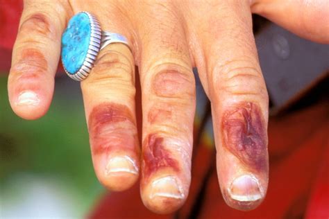 Effects of the treatment with nifedipine on the temperature (°c) of fingers (average for both. Frostbite - Symptoms - NHS