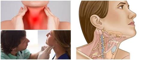 Ganglios Inflamados En El Cuello Características Causas Síntomas