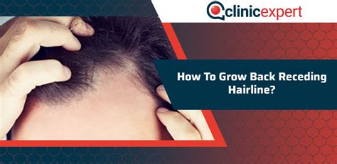 How To Grow Back Receding Hairline Clinicexpert