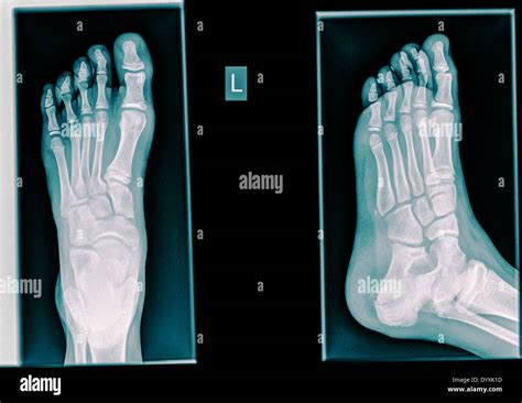 Healthy X Ray Ofa Foot Of A 12 Year Old Male Stock Photo Alamy