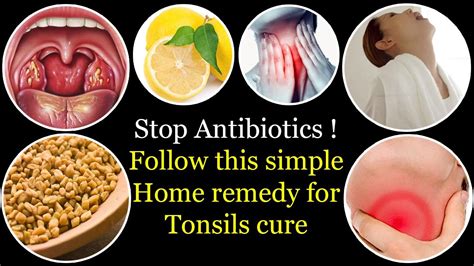 Relieving Tonsillitis Without Medication Natural Remedies To Manage