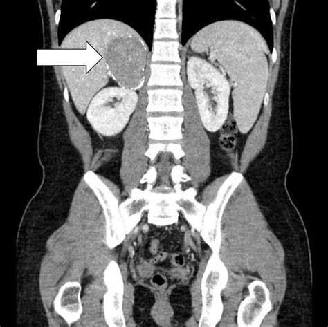 Ct Image Right Adrenal Gland Cft Download Scientific Diagram