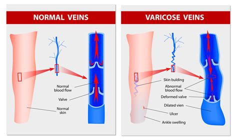 What Are Varicose Veins And How To Treat Them Aesthetics Hub