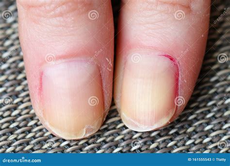Splitting And Peeling Nails Stock Image Image Of Condition Woman