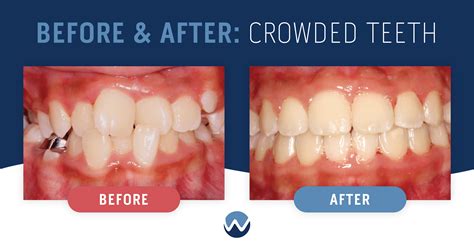 Ways We Can Help With Teeth Crowding • Woodhill Dental Specialties