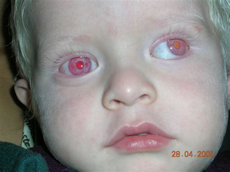 Albinismo Oculare