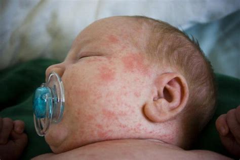 Toxic Erythema Of The Newborn Causes Treatment