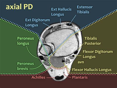 The deformity of the foot with abnormal pressure distribution on the plantar surface coupled with reduced or loss of sensation, makes the foot. Foot Muscles Mri Anatomy : Anatomy Of The Foot And Ankle ...