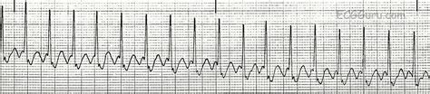 Ecg Basics Atrial Flutter With 21 Conduction Ratio Rhythm Strip