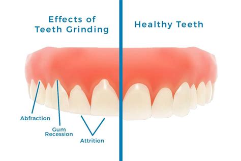 How To Stop Clenching Teeth To Protect Your Smile Melton Dental House