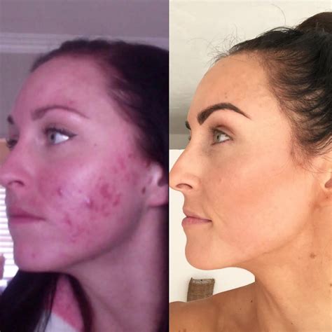 This Food Blogger Kept It Real About Her Cystic Acne Scars In This