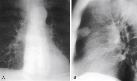 Solitary Pulmonary Nodule Radiology Key