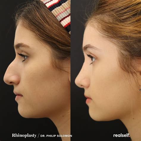 Rhinoplasty The Ultimate Guide To Nose Jobs Realself Rhinoplasty Before And After