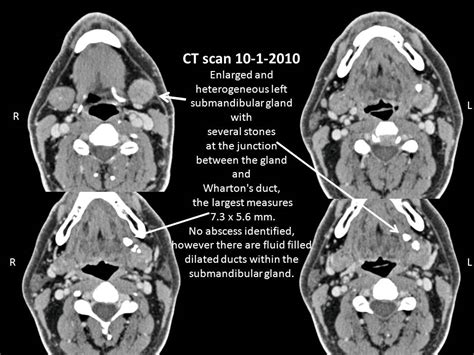 Case Example Retained Submandibular Stone After Submandibular Gland
