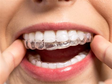 Does The First Invisalign Tray Move Your Teeth