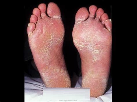 Candida Skin Fungus Medical Pictures Info Health Definitions Photos