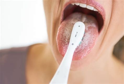 What Causes White Tongue Savina Dental Clinics Malta And Gozo