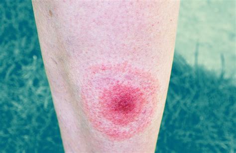 What Does A Lyme Disease Rash Really Look Like These Pictures Explain It