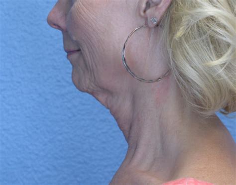 Reno Mini Face And Neck Lift Before And After Photos