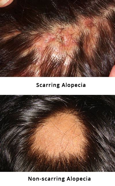 Alopecia Areata Hair Loss In Patches Dr Health