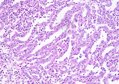 Pathology Outlines Collecting Duct Carcinoma