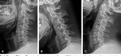 Figure 1 From Does Preoperative Cervical Sagittal Alignment And Range