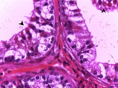 Cureus Eosinophilic Metaplasia In The Epididymis In Association With